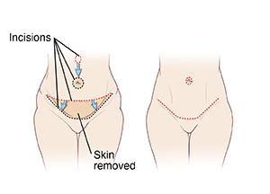 Abdominoplasty (Tummy Tuck)