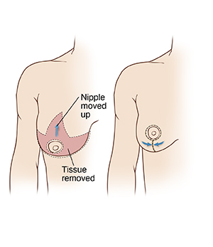 Your nipples and breast reduction