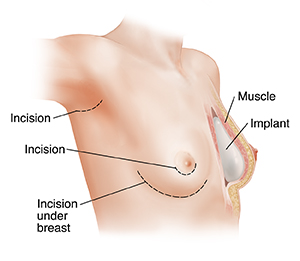 Breast Lift or Implants  Saint Luke's Health System