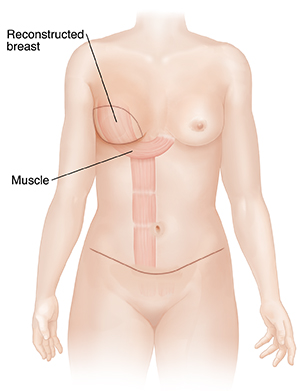 Mastectomy with Reconstruction