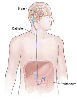 Having a Ventriculoperitoneal Shunt