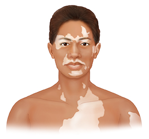 Front view of woman’s head and shoulders with light patches of skin on face, neck, and chest.