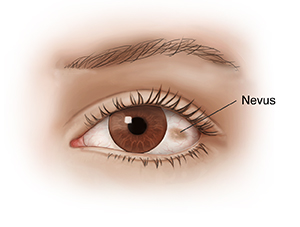 Front view of eye with nevus.