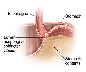 Understanding Endoscopic Magnetic Esophageal Sphincter