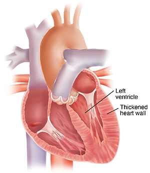 Cross section of heart with left ventricular hypertrophy. Walls of left ventricle are thickened.