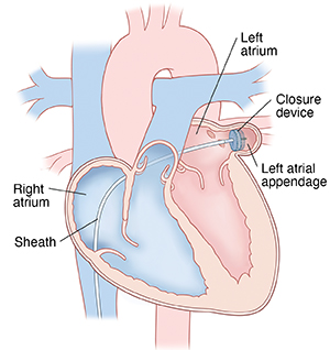 Left Atrial Appendage and Closure (LAAC) | Saint Luke's Health System