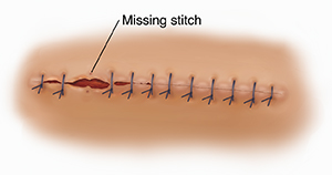Top view of sutured wound showing missing stitches and partial opening of the wound (dehiscence).