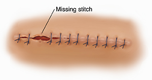 Signs of Infection After Surgery