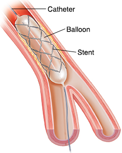 Coronary Stents Saint Luke s Health System