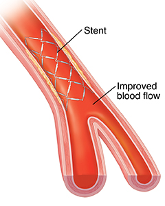 Coronary Stents Saint Luke s Health System