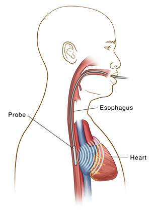 Transesophageal Echocardiogram (TEE)