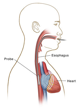 Transesophageal echocardiogram - Wikipedia