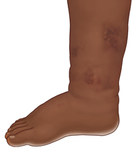 Side view of leg showing ankle and foot swelling.