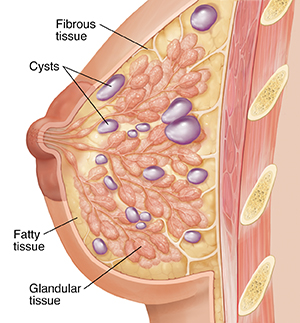 Side view cross section of breast showing glandular, fibrous, and fatty tissue.  Multiple cysts throughout breast.