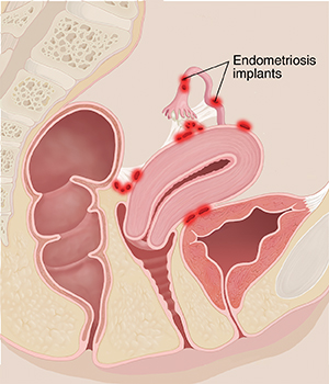 What Is Endometriosis?  Saint Luke's Health System