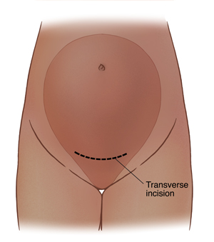 TOLAC (Trial of Labor After Cesarean Delivery) | Saint Luke&rsquo;s 