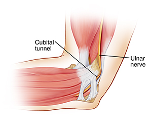 Ulnar Nerve Entrapment at the Elbow (Cubital Tunnel Syndrome