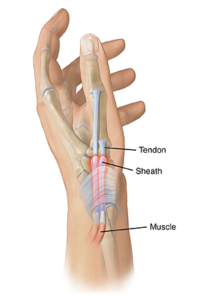 De Quervain's Tendinosis (Tendonitis At The Wrist) Gordon, 55% OFF