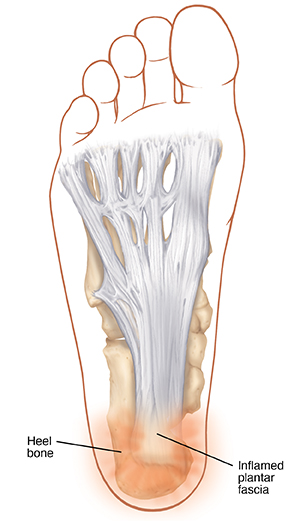 Bottom of deals foot heel pain