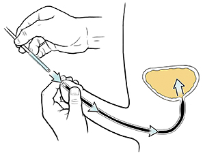 Closeup of hands inserting catheter into penis.  