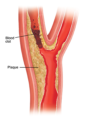 Can a high blood store pressure cause a stroke