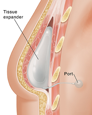 Cross section of breast showing tissue expander after mastectomy.