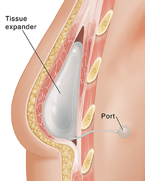 Breast Lift or Implants  Saint Luke's Health System