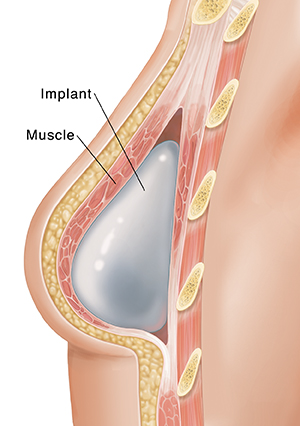 Breast Lift or Implants  Saint Luke's Health System