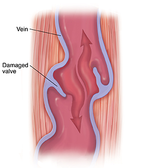 Cross section of muscle and vein showing damaged valve. Arrow shows blood moving down.