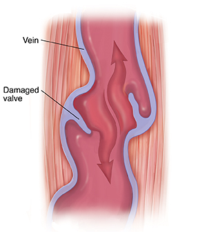 Understanding Chronic Venous Insufficiency