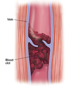 Cross section of muscle and vein with blood clot.