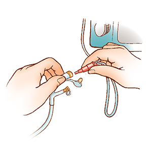 Closeup of hands holding plug-in feeding bag tubing and plug-in feeding tube port.