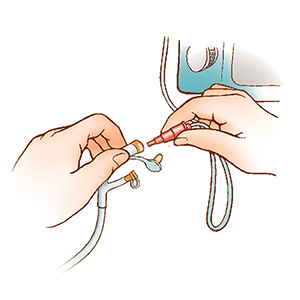 Gastrostomy Feeding Tube Care: Flushing