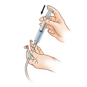Closeup of hands holding plug-in syringe in feeding tube port, pressing plunger to flush water into feeding tube.