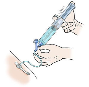Closeup of hands holding twist-on syringe in feeding tube port, pressing plunger to flush water into feeding tube.