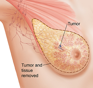 Types of Surgery for Breast Cancer