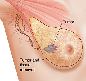 Surgery to remove lymph nodes from your armpit