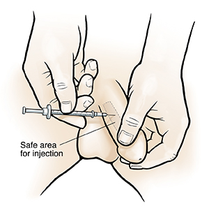 Penile Self Injection Procedure Saint Luke s Health System