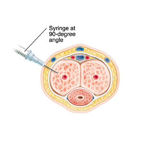 Penile Self Injection Procedure Saint Luke S Health System