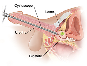 Laser Prostatectomy Saint Luke s Health System