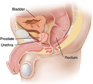 Chronic Prostatitis Chronic Pelvic Pain Syndrome Saint Luke s