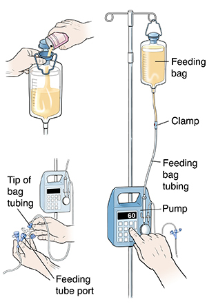 Peg tube feeding bags sale