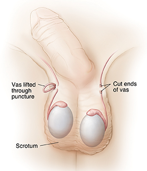 Prairie Vasectomy, No Needle. No Scalpel.