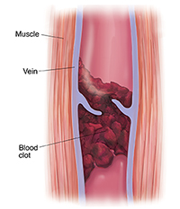 How To Treat Deep Vein Thrombosis?