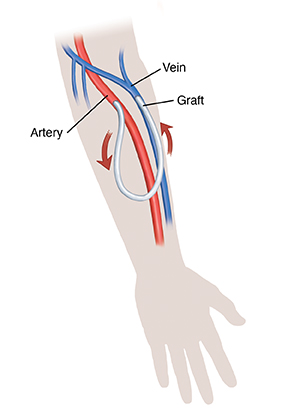 Silhouette of hand and forearm showing graft for hemodialysis. Arrows show blood flow through graft.