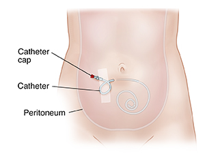 Everything You Need to Know About The Peritoneal Dialysis Catheter  Insertion Procedure