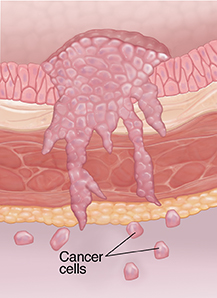 Staging of Bladder Cancer | Saint Luke's Health System