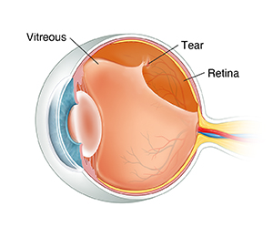 What is the Retina? Retinal detachment and other retinal issues.