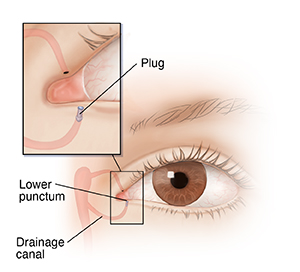 Punctal plugs - Mayo Clinic