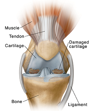 Osteoarthritis